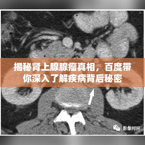 揭秘腎上腺腺瘤真相，百度帶你深入了解疾病背后秘密