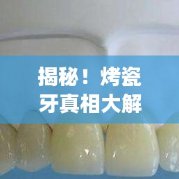 揭秘！烤瓷牙真相大解密，專業(yè)解讀烤瓷牙的優(yōu)缺點