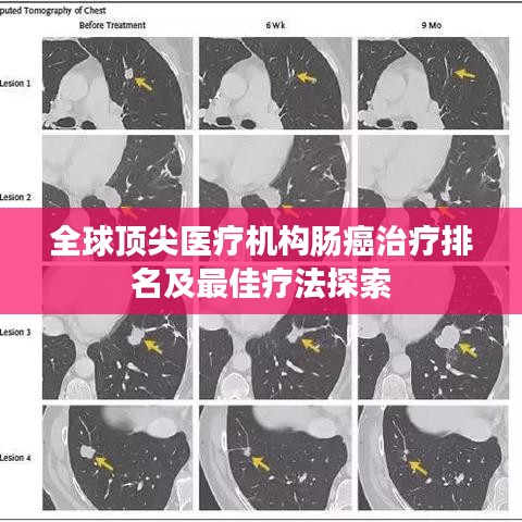 全球頂尖醫(yī)療機(jī)構(gòu)腸癌治療排名及最佳療法探索